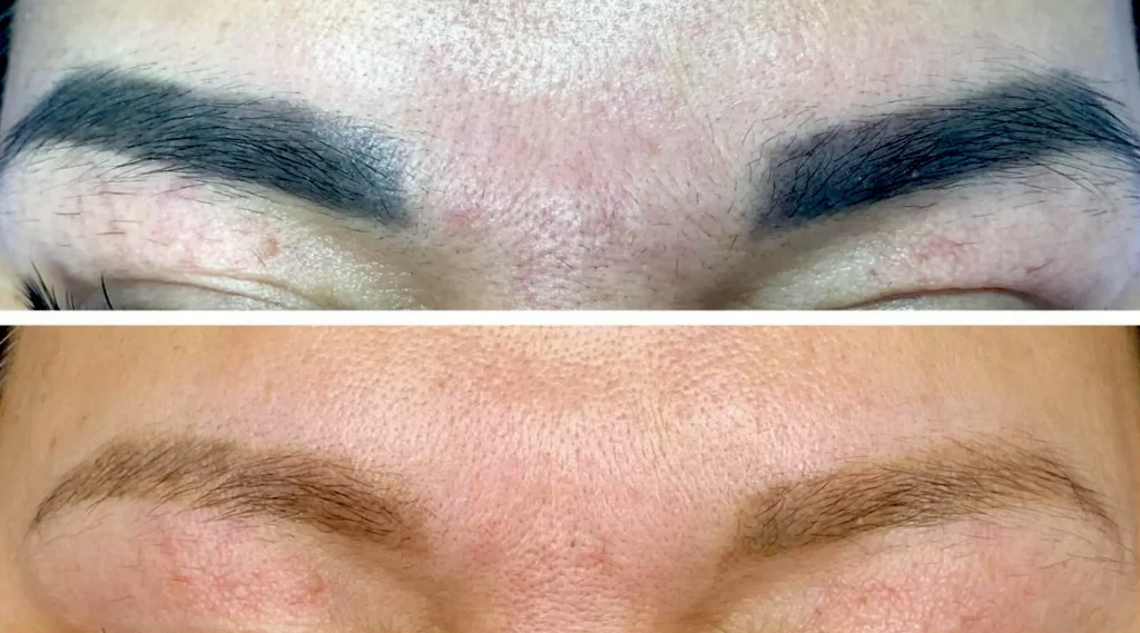 brow tattoo removal