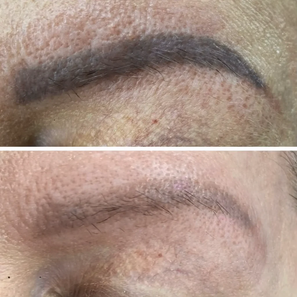 eyebrow laser removal