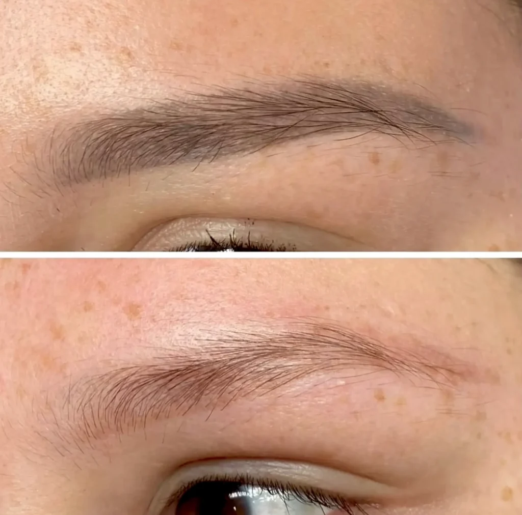 eyebrow tattoo removal