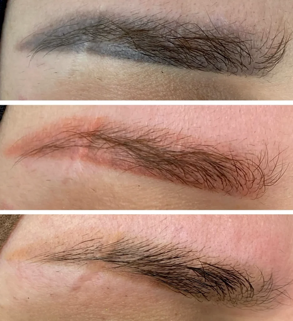 eyebrow tattoo removal cost