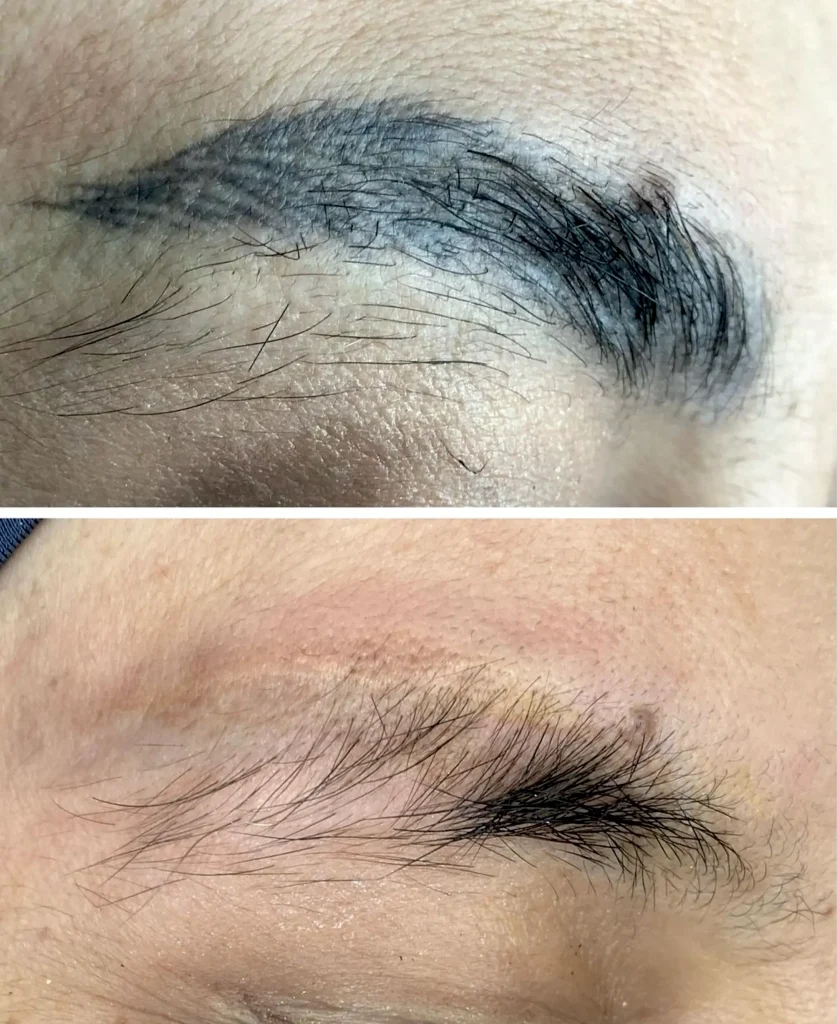 eyebrow tattoo removal near me