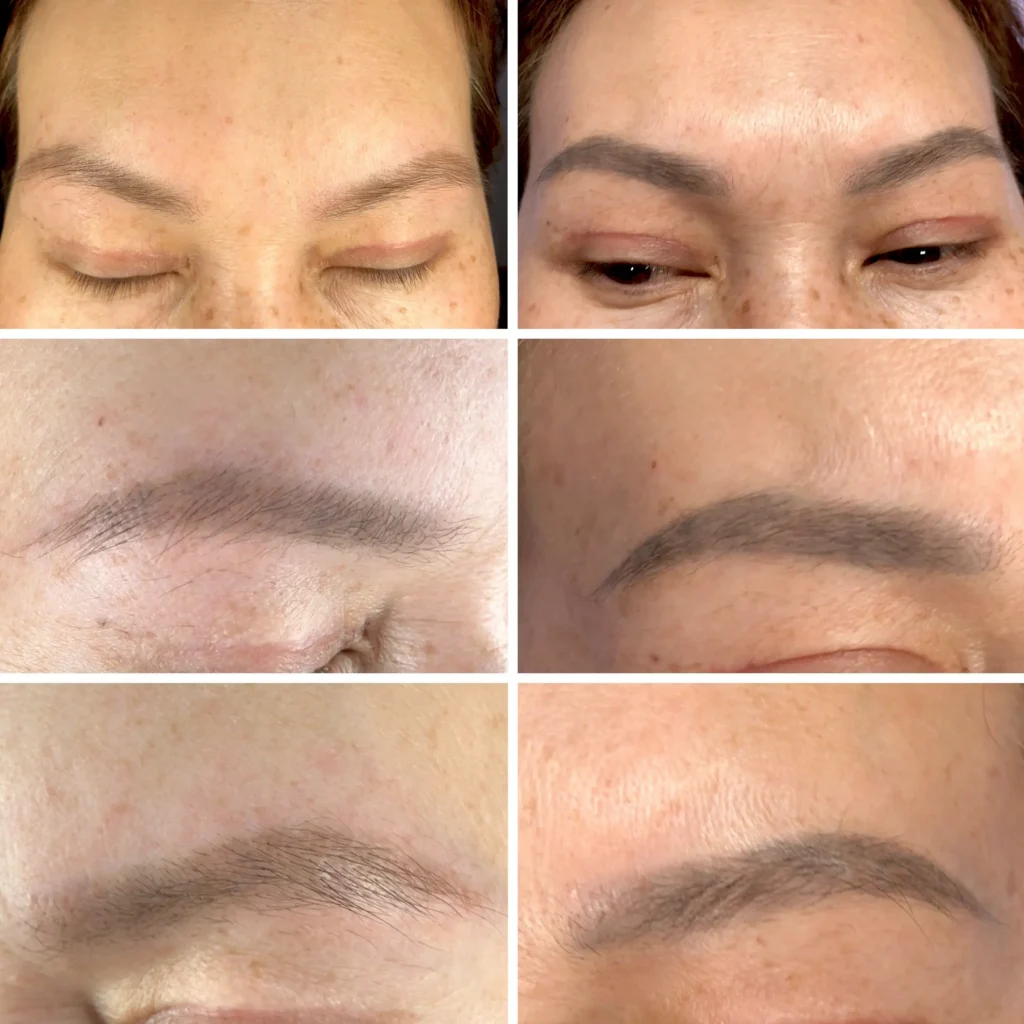 laser eyebrow tattoo removal before and after