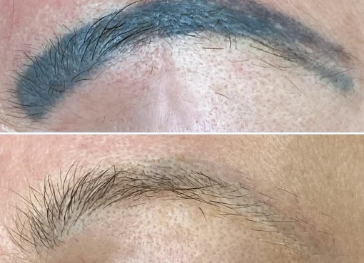 laser tattoo removal eyebrows