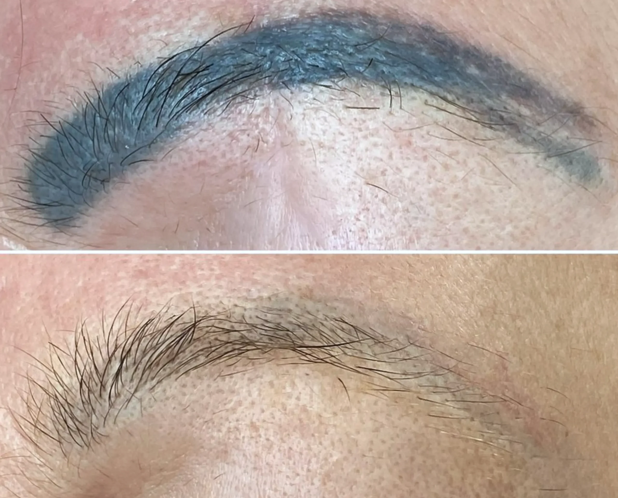 laser tattoo removal eyebrows