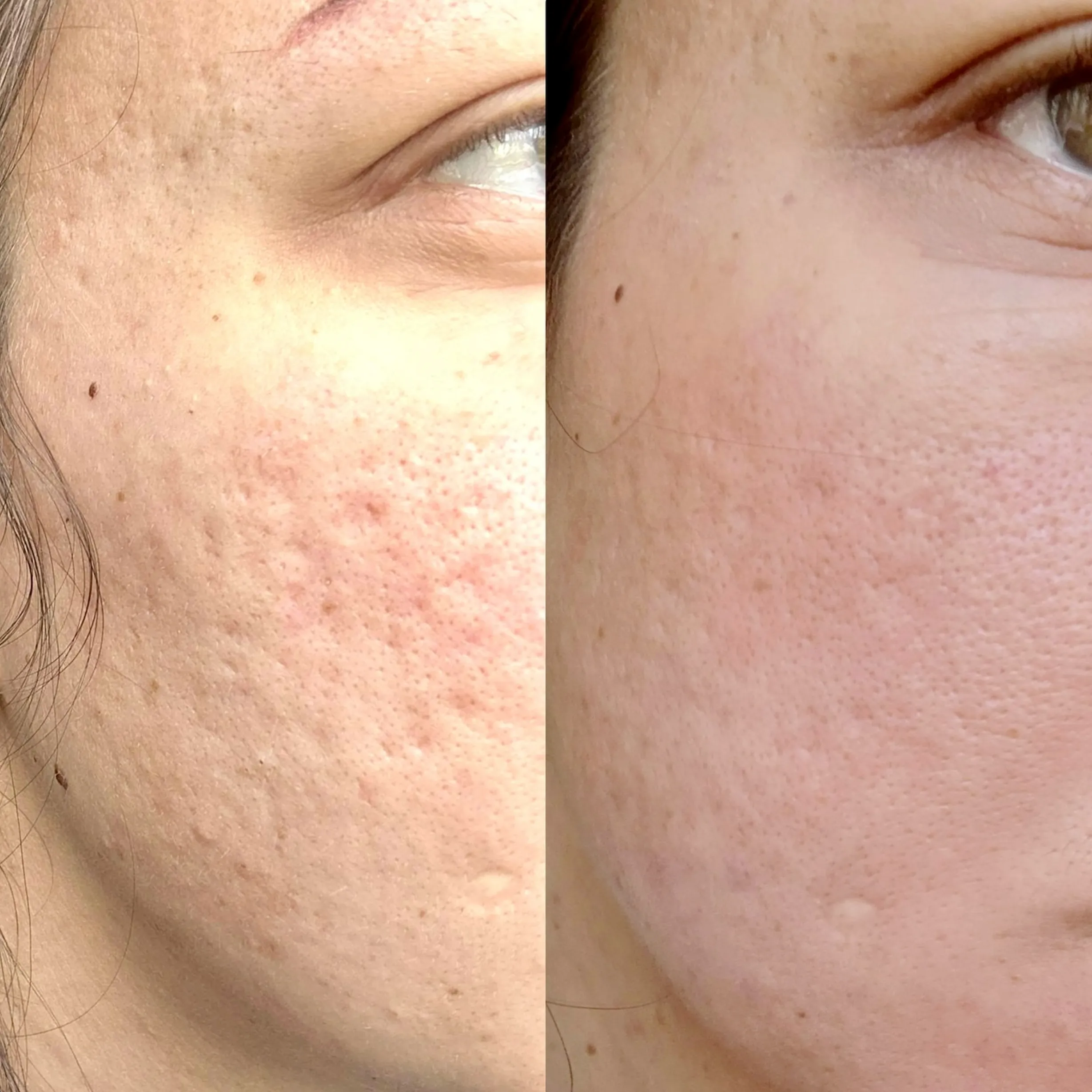 facial schedule for acne