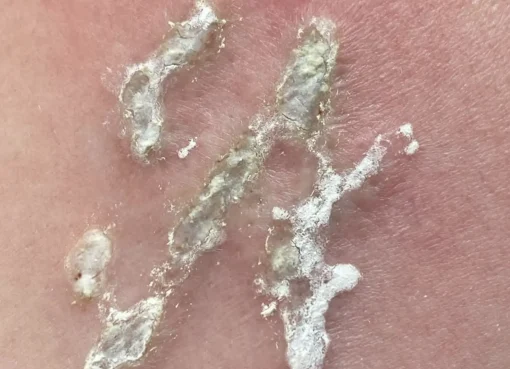 tattoo removal training uk
