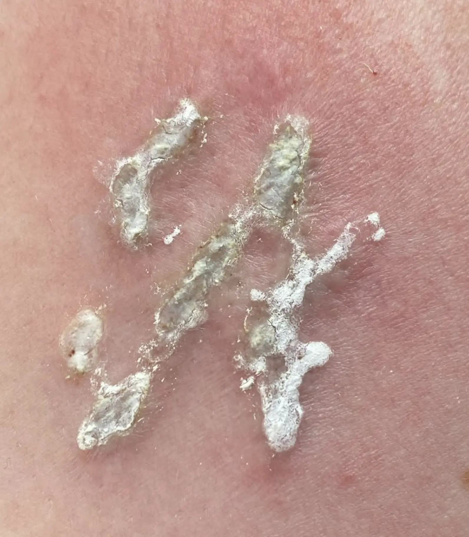 What Are The Latest 2026 Protocols For Managing Blistering And Post-Treatment Tattoo Removal Wound Care To Avoid Scarring?